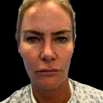 before-deep-plane-facelift-necklift-blepharoplasty